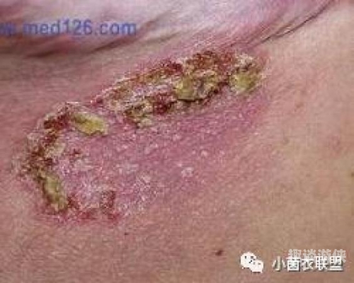 如何准确区分股癣与阴囊湿疹——从症状到治疗的全面解析怎么判断是股癣还是阴囊湿疹